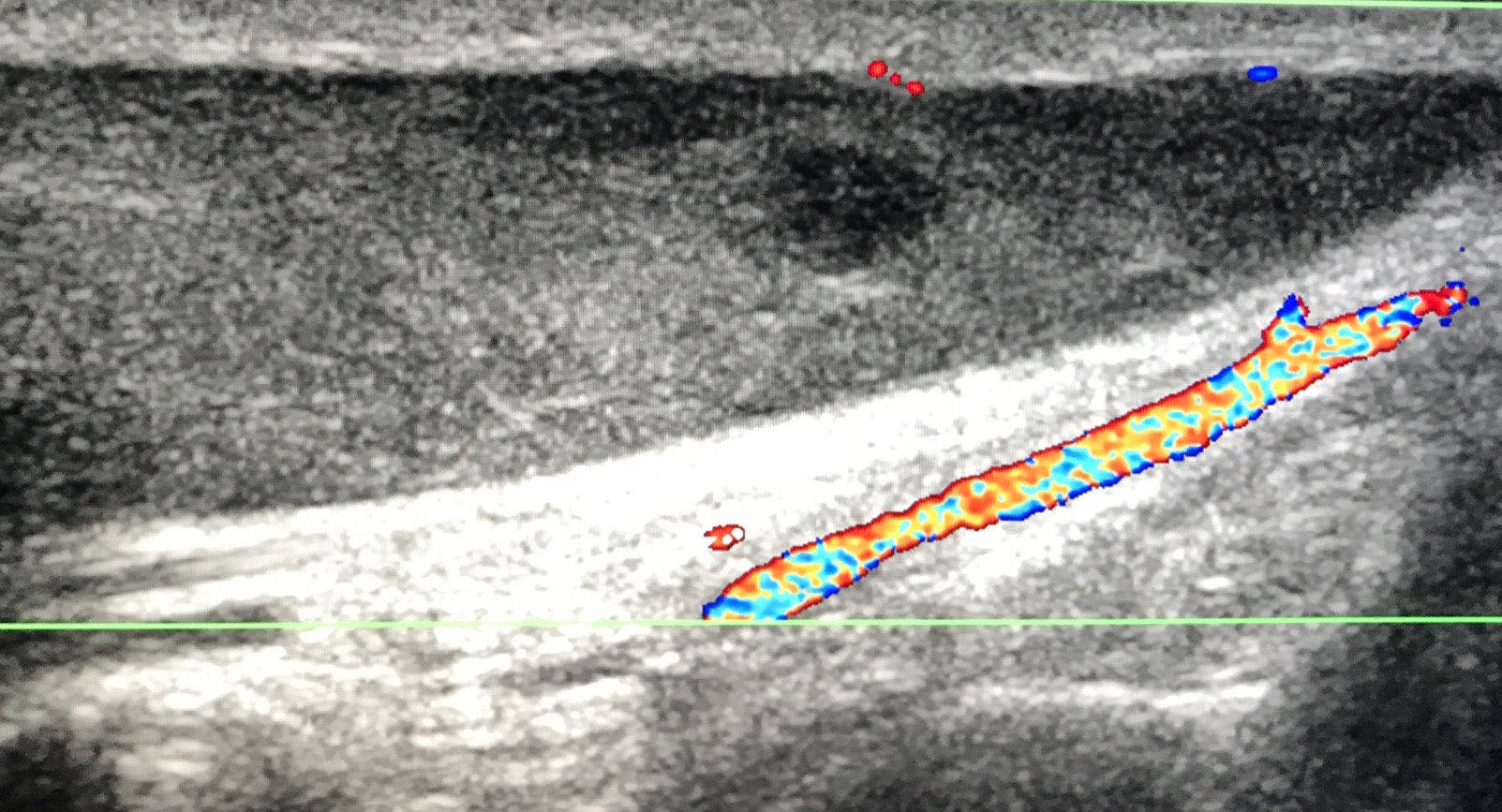 Figure 5 for case synovial sarcoma ( RID4558 ) of the ankle